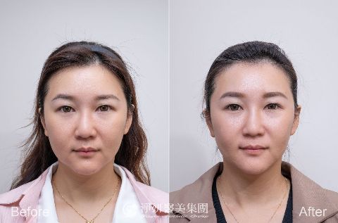 10蓓電波900條 (淨妍醫美(忠孝)案例)