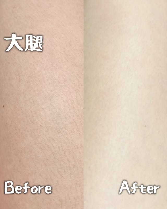德國Epilab艾比雷射一台機器兩種功用 無痛除毛+鈦提升拉提