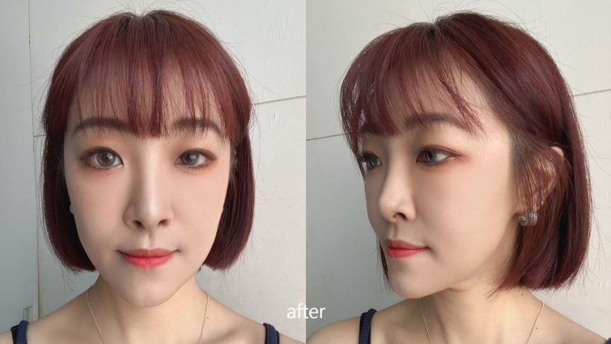 艾玻玻尿酸全紀錄，真實見證、術後注意事項， 打造精緻自然幼態臉