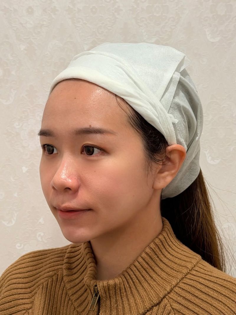 玻尿酸法令紋、改善疲累臉，玻尿酸下巴、打造側臉的輪廓感