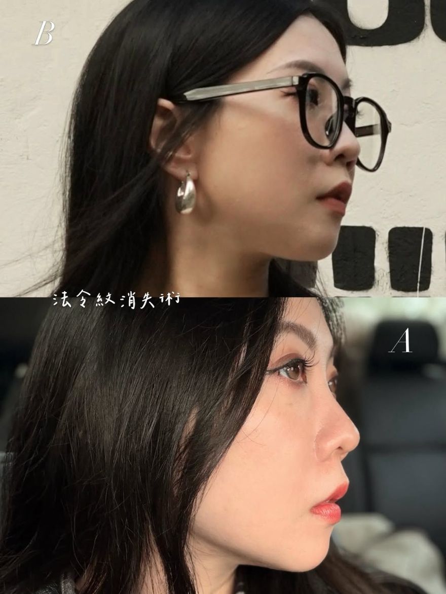 法令紋隨著年紀增長越來越明顯，艾玻玻尿酸法令紋效果非常滿意