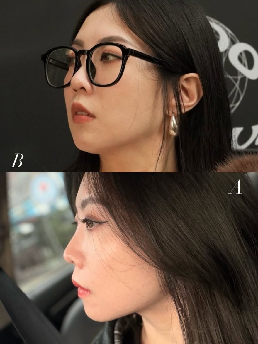 法令紋隨著年紀增長越來越明顯，艾玻玻尿酸法令紋效果非常滿意