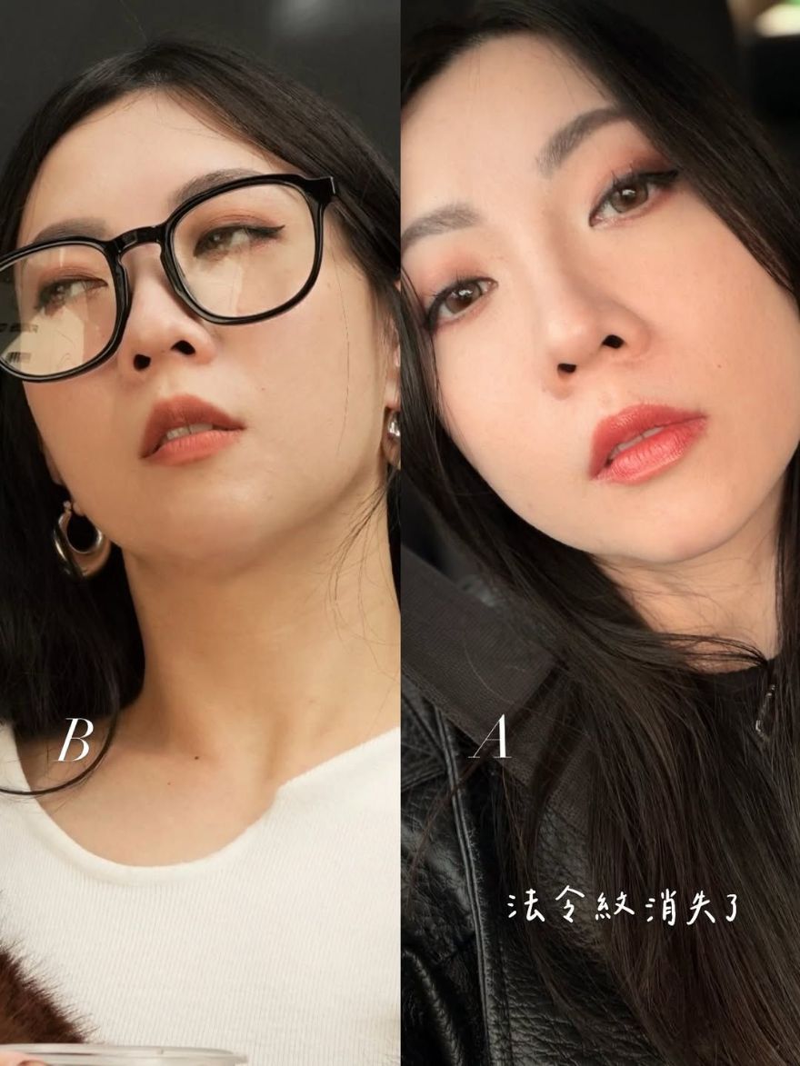 法令紋隨著年紀增長越來越明顯，艾玻玻尿酸法令紋效果非常滿意