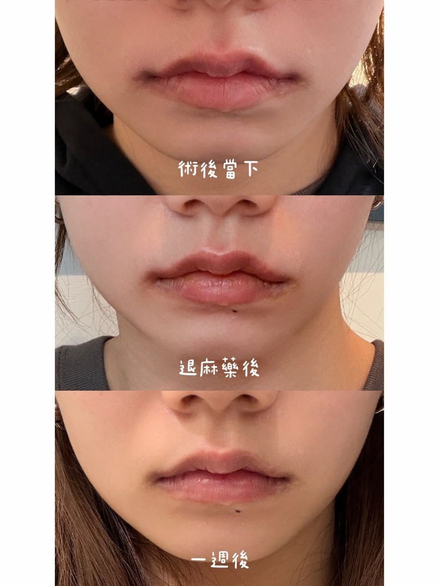 玻尿酸嘴唇，嘴角修飾、唇珠立體，一點小改變就能影響臉部整體