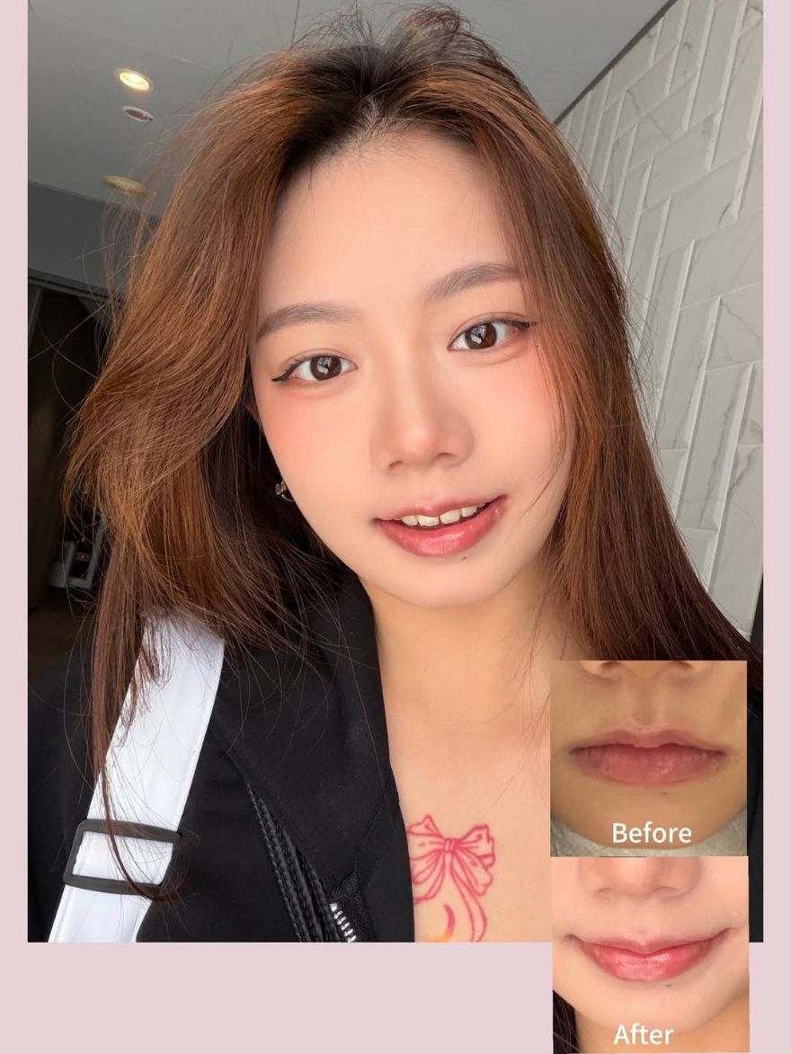 玻尿酸嘴唇，嘴角修飾、唇珠立體，一點小改變就能影響臉部整體