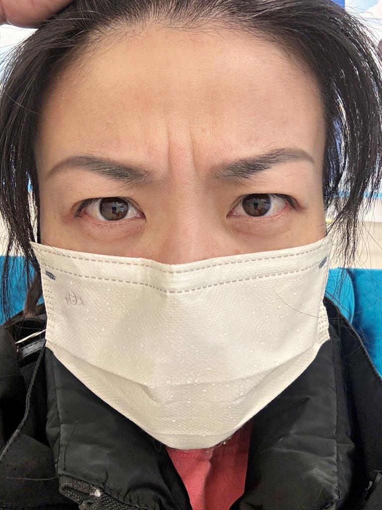 淨妍醫美診所 彩虹肉毒抬頭紋+小臉 立即有感! 跟大餅臉說掰掰~找回青春與自信
