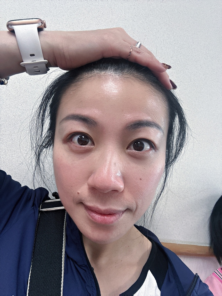 淨妍醫美診所 彩虹肉毒抬頭紋+小臉 立即有感! 跟大餅臉說掰掰~找回青春與自信!