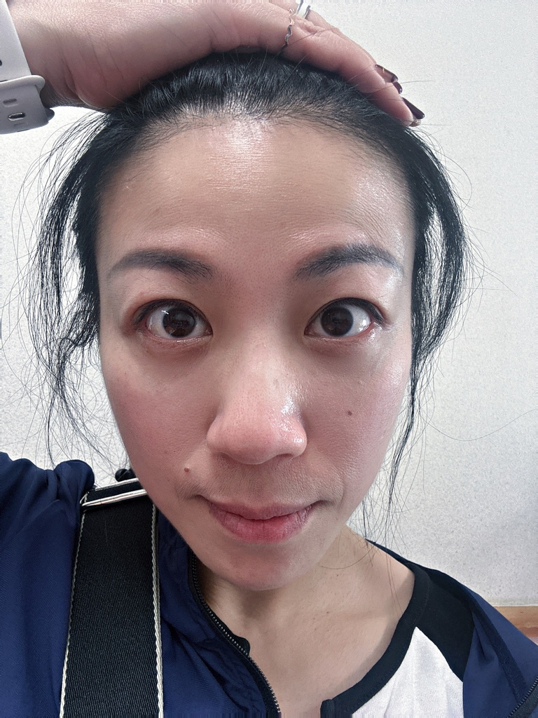 淨妍醫美診所 彩虹肉毒抬頭紋+小臉 立即有感! 跟大餅臉說掰掰~找回青春與自信!