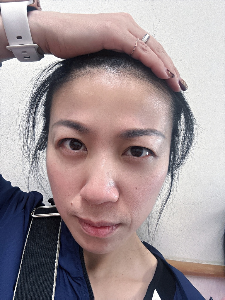 淨妍醫美診所 彩虹肉毒抬頭紋+小臉 立即有感! 跟大餅臉說掰掰~找回青春與自信!
