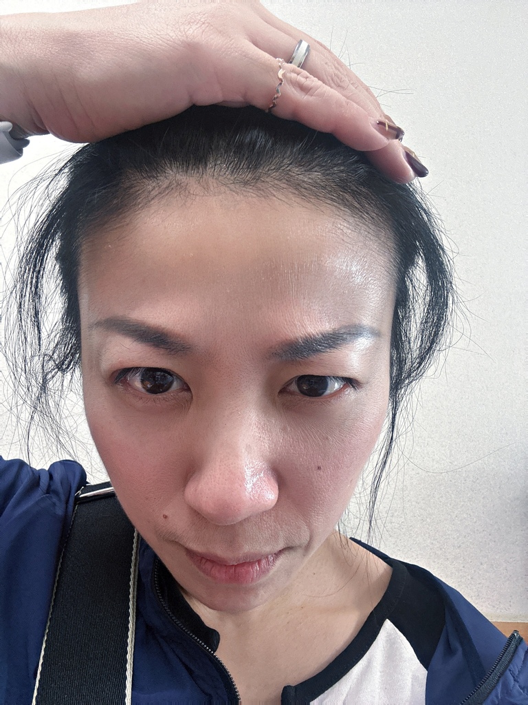 淨妍醫美診所 彩虹肉毒抬頭紋+小臉 立即有感! 跟大餅臉說掰掰~找回青春與自信!