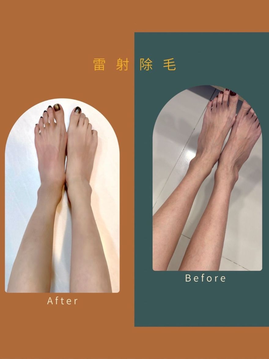 桃園淨妍醫美診所體驗雷射除毛–比除毛刀、熱蠟除毛更好的選擇