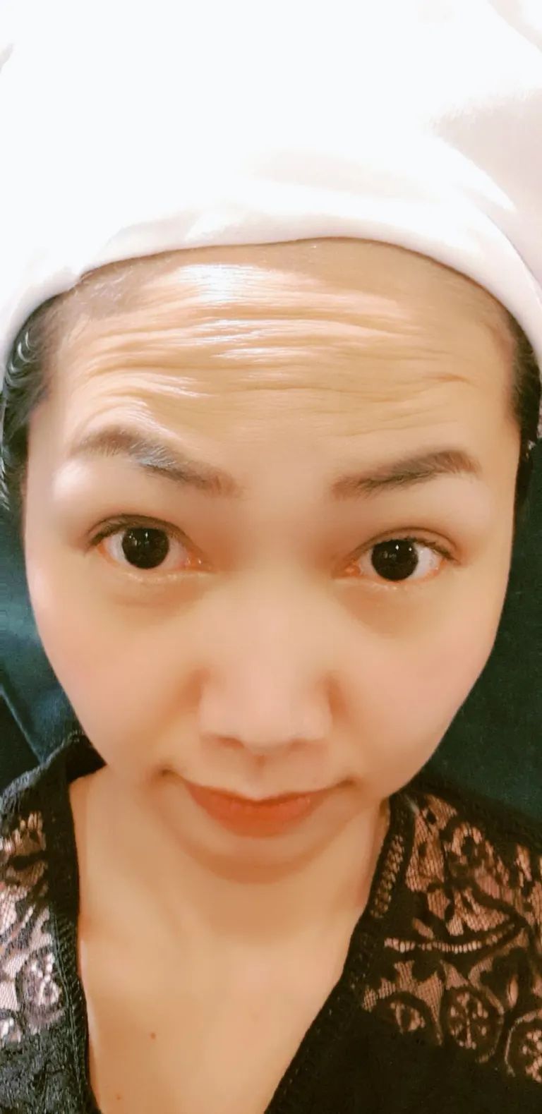 中山淨妍醫美診所彩虹肉毒除皺瘦小臉
