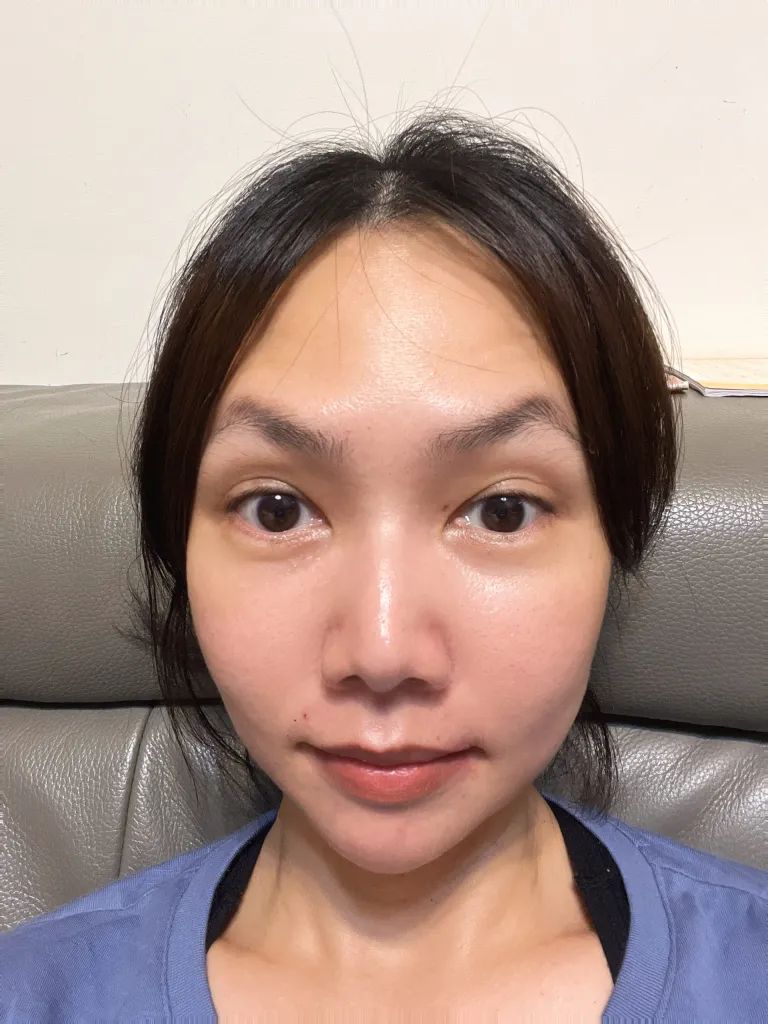 中山淨妍醫美診所彩虹肉毒除皺瘦小臉