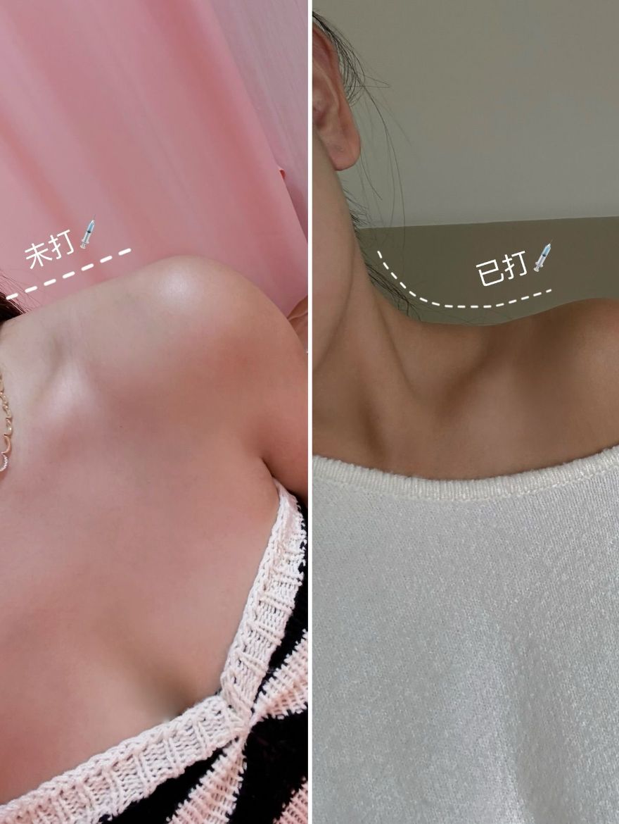 新莊醫美｜打造精緻直角肩，肉毒肩膀一併改善了圓背和肩頸緊繃