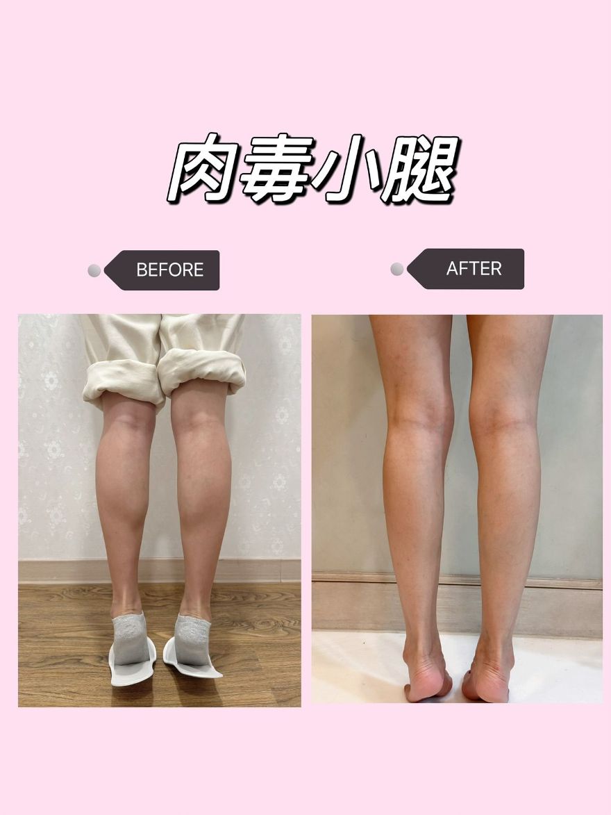 長期規律運動，小腿肌卻越來越明顯！桃園淨妍醫美施打肉毒小腿修飾小腿線條