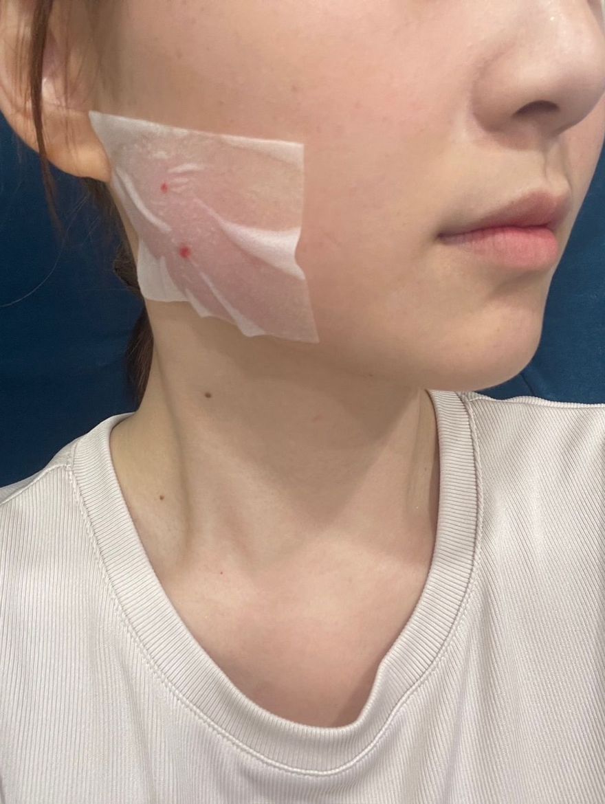 最在意的嘴邊肉&嬰兒肥，肉毒咀嚼肌效果很自然，線條修飾得剛剛好