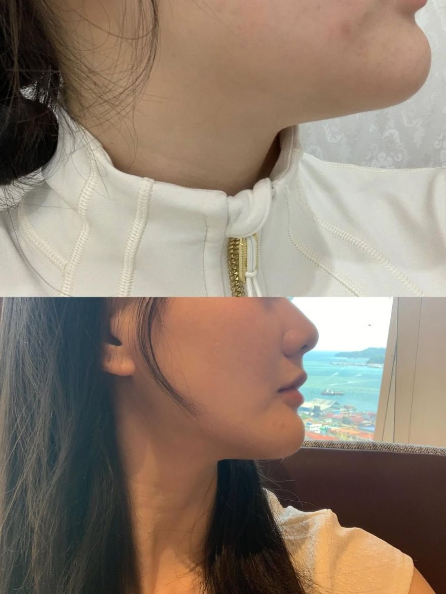 肉毒拉提下顎線、肉毒除皺抬頭紋！找對醫生很重要