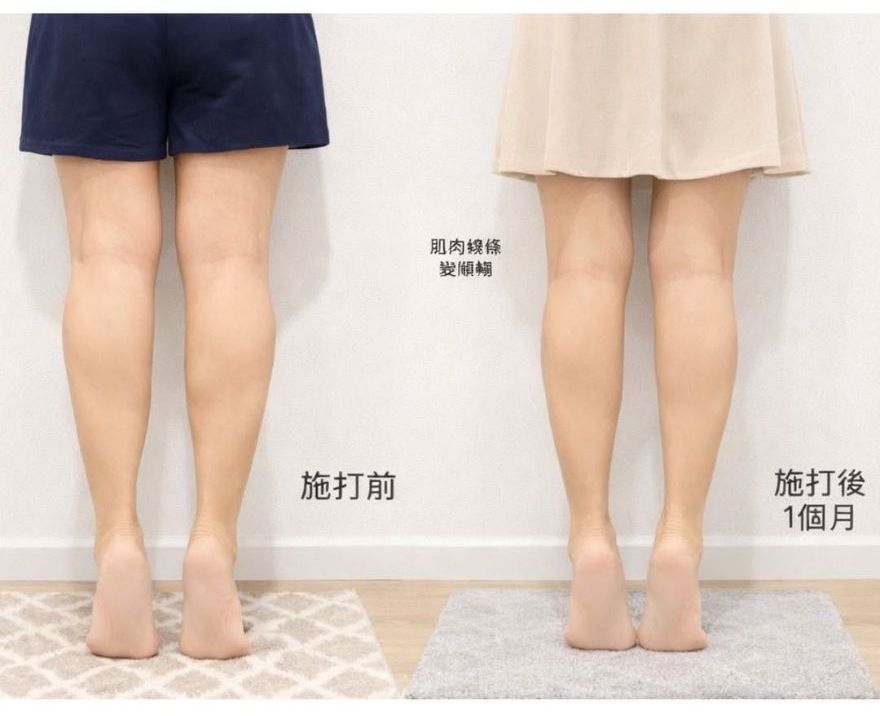 肌肉型小腿很難瘦,靠肉毒改善肌肉線條,比例都變好了
