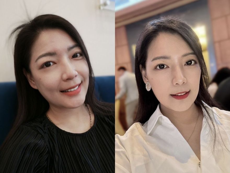 肉毒抬頭紋、咀嚼肌！快速方便的午間美容