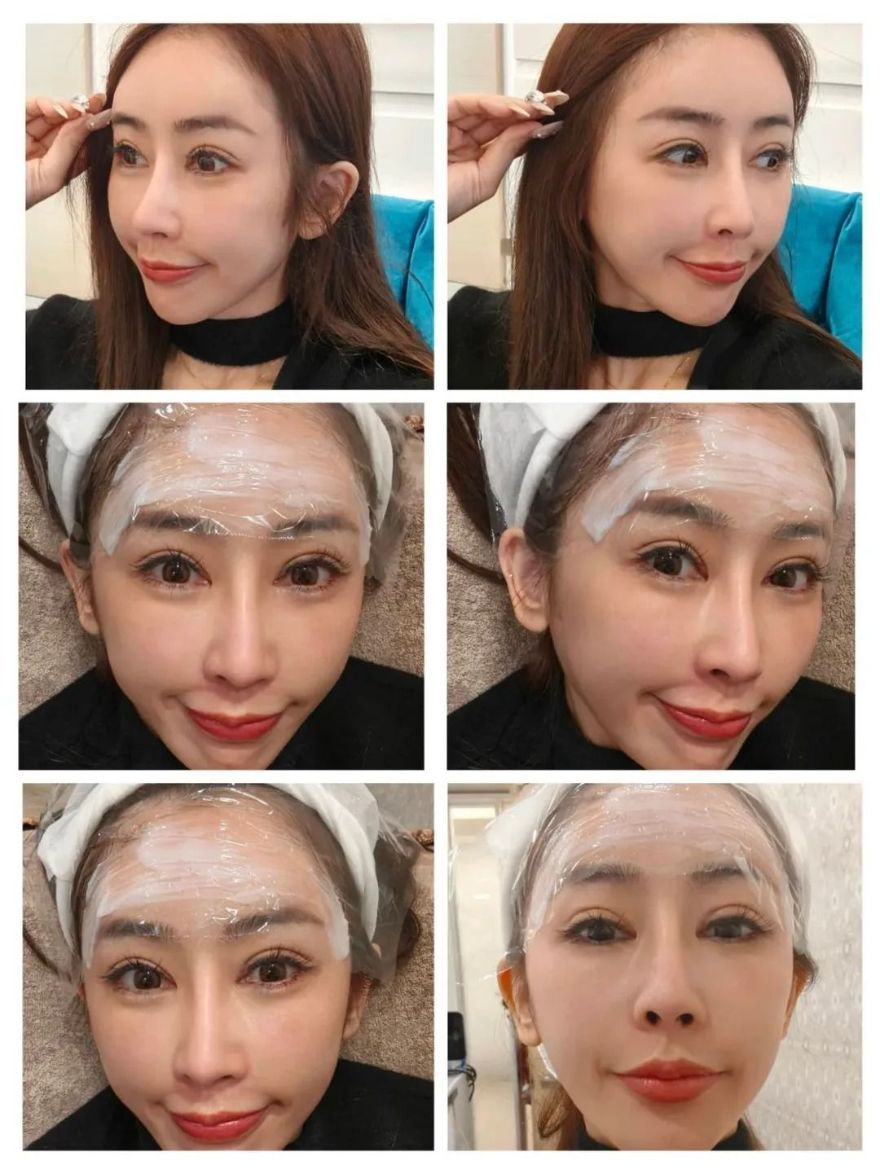 線條飽滿、側面完美弧度！交給淨妍醫美專業醫師評估，打造韓系柔美額頭