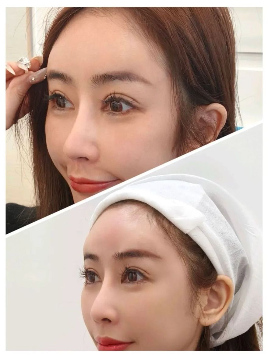 線條飽滿、側面完美弧度！交給淨妍醫美專業醫師評估，打造韓系柔美額頭