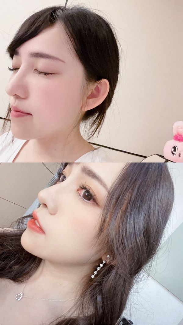 一躺下雙下巴就跑出來...護理師推薦安全性佳的Onda pro超微波，推薦有雙下巴困擾的人