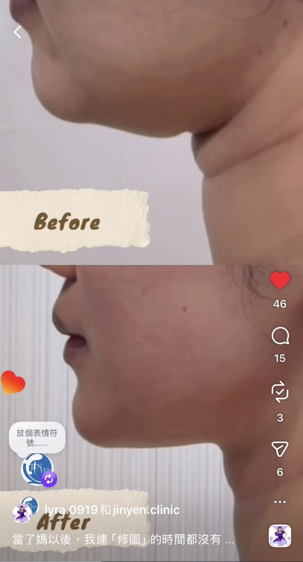 見證ONDA PRO超微波12分鐘的奇蹟！產後媽媽的福星，重新找回輪廓線