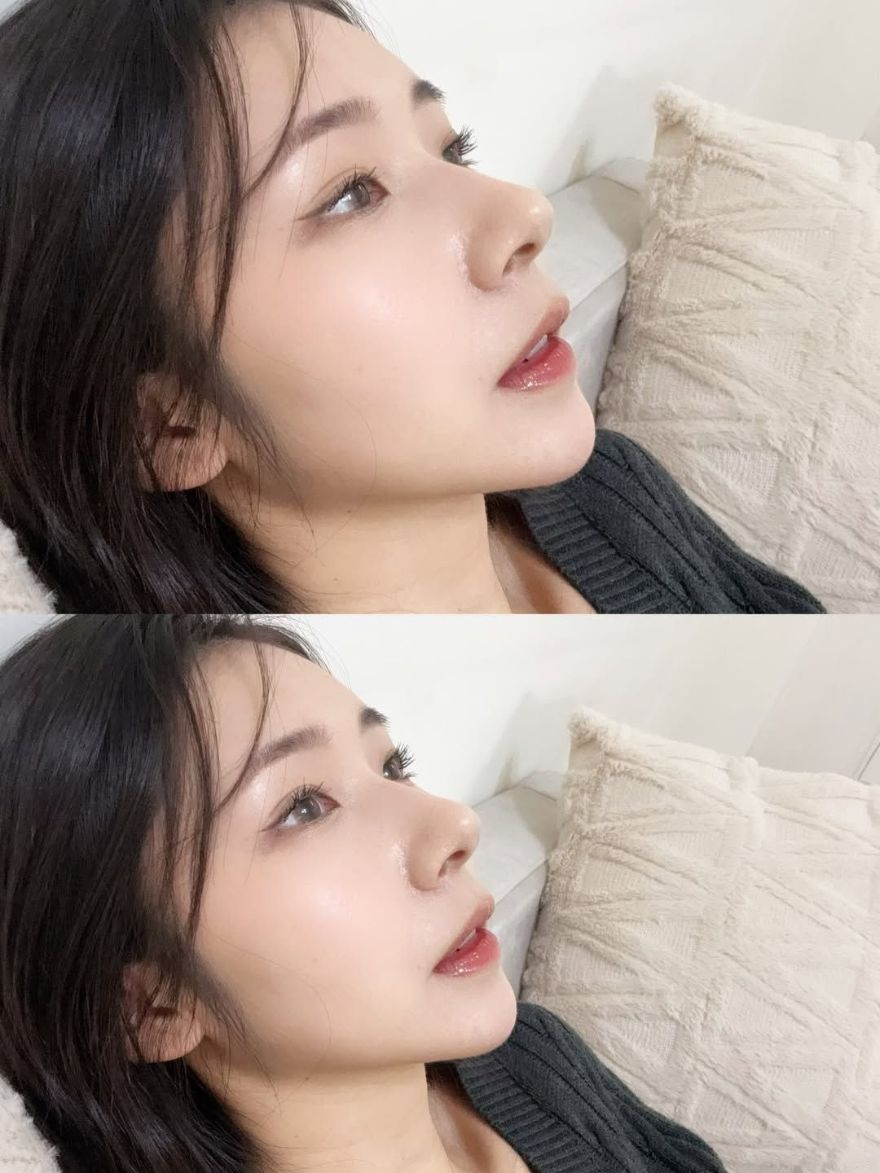 關注好久的Onda Pro超微波，終於有機會親身體驗，下顎線真的差好多～