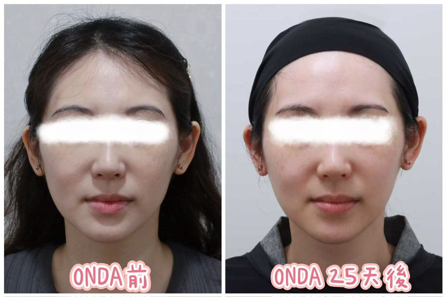 ONDA Pro 超微波|低疼痛感的肉肉臉剋星!
