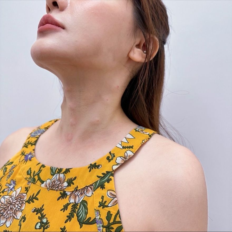 低頭族的困擾、脖子逐漸長出紋路，Profhilo逆時針不僅可深層保濕，還能提升肌膚緊緻度