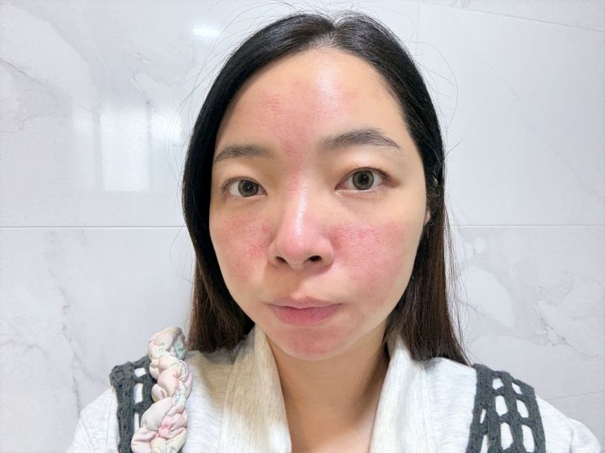 「皮秒雷射+Rejuran麗珠蘭」台北醫美推薦，出國拍照必備保養，細緻肌膚毫無死角！