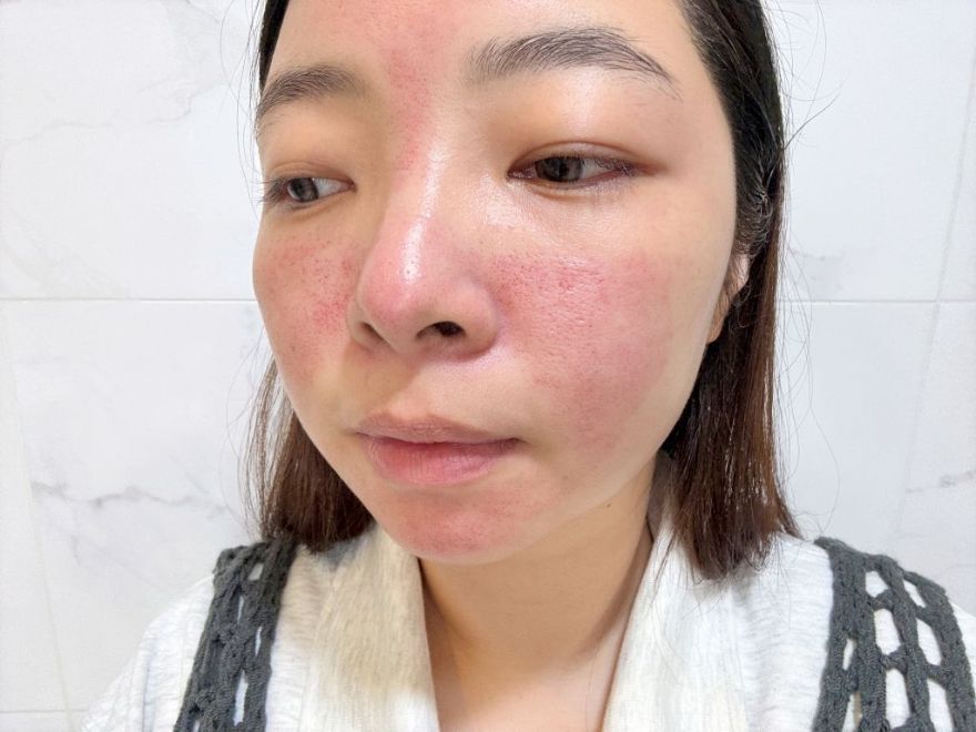 「皮秒雷射+Rejuran麗珠蘭」台北醫美推薦，出國拍照必備保養，細緻肌膚毫無死角！