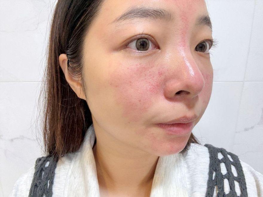 「皮秒雷射+Rejuran麗珠蘭」台北醫美推薦，出國拍照必備保養，細緻肌膚毫無死角！