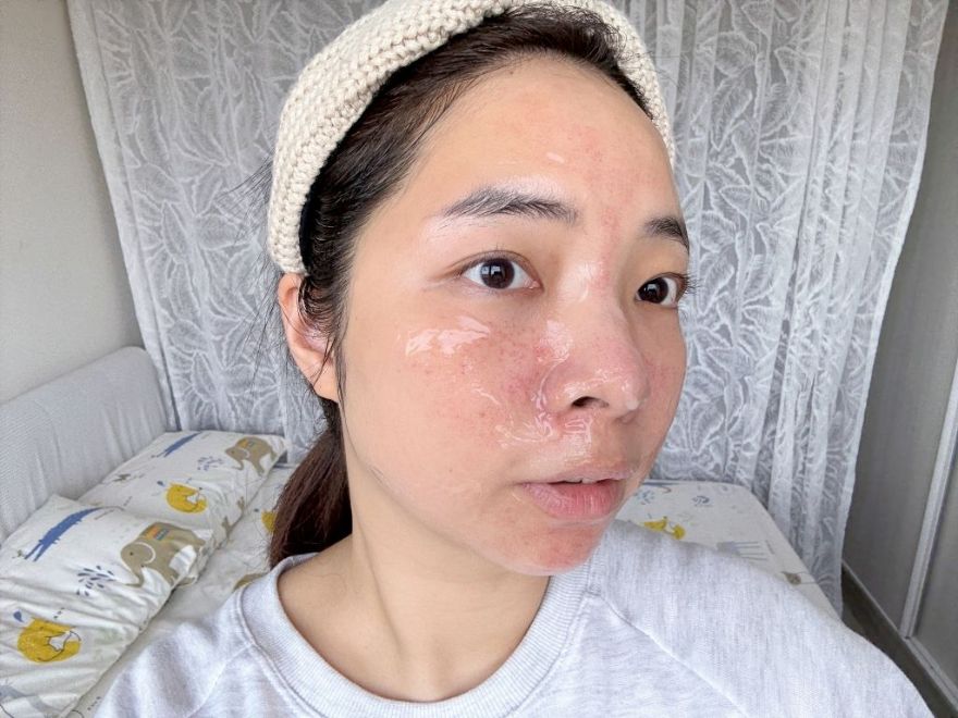 「皮秒雷射+Rejuran麗珠蘭」台北醫美推薦，出國拍照必備保養，細緻肌膚毫無死角！