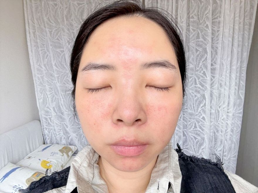 「皮秒雷射+Rejuran麗珠蘭」台北醫美推薦，出國拍照必備保養，細緻肌膚毫無死角！