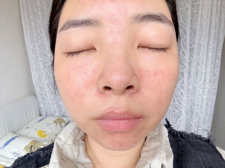 「皮秒雷射+Rejuran麗珠蘭」台北醫美推薦，出國拍照必備保養，細緻肌膚毫無死角！