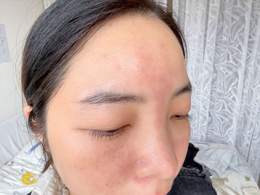 「皮秒雷射+Rejuran麗珠蘭」台北醫美推薦，出國拍照必備保養，細緻肌膚毫無死角！