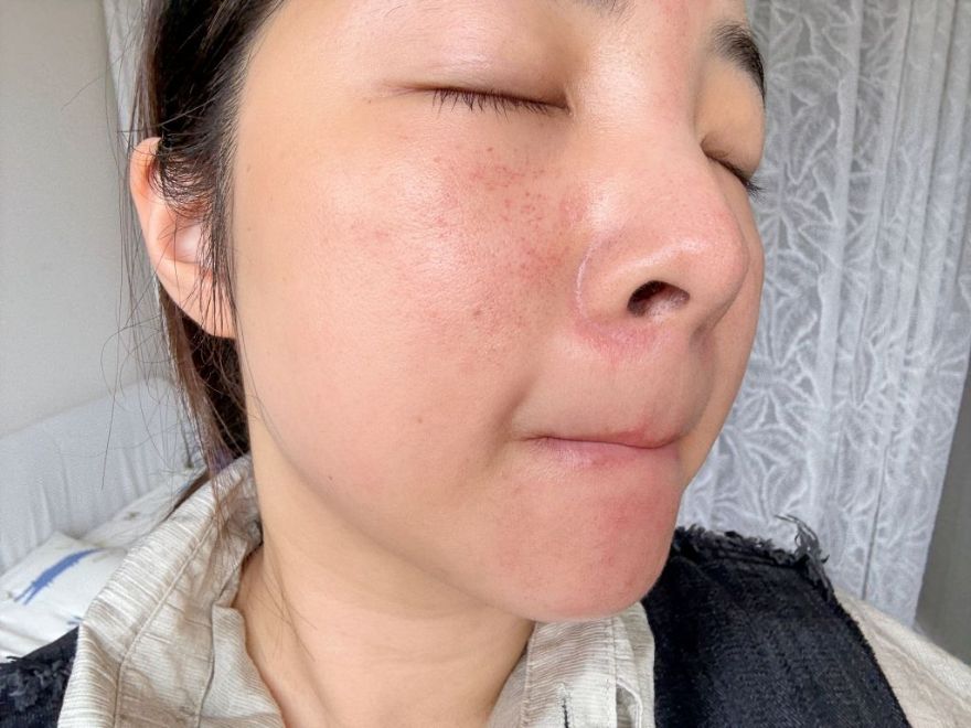 「皮秒雷射+Rejuran麗珠蘭」台北醫美推薦，出國拍照必備保養，細緻肌膚毫無死角！