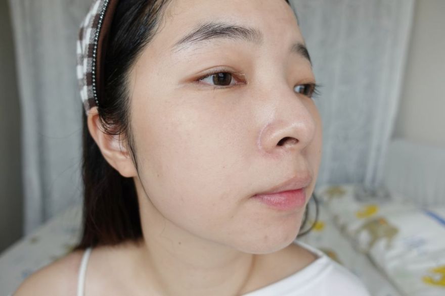 「皮秒雷射+Rejuran麗珠蘭」台北醫美推薦，出國拍照必備保養，細緻肌膚毫無死角！