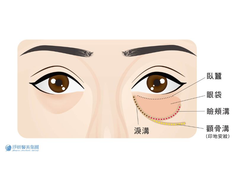 第十六屆淨妍學院課程探討玻尿酸填補淚溝