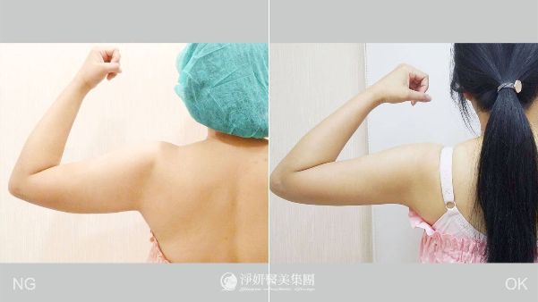 抽脂手術瘦手臂-殷紹閔醫師案例於高雄淨妍診所