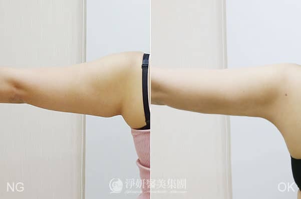 抽脂手術瘦手臂與改善副乳-殷紹閔醫師案例於高雄淨妍診所