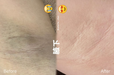 艾比雷射除毛案例分享_主持人鴨鴨