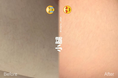 艾比雷射除毛案例分享_主持人鴨鴨
