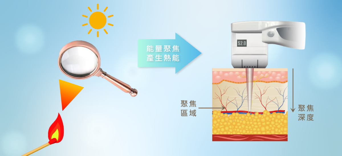 LiftSonic麗芙音波Ⅲ 高能量聚焦超音波