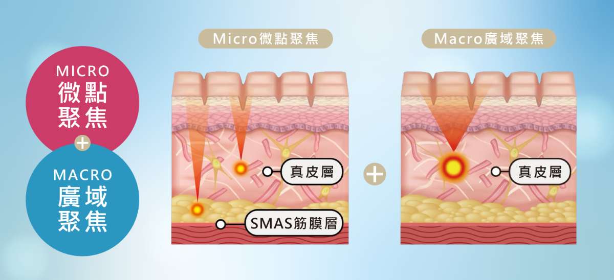新一代LiftSonic麗芙音波Ⅲ  MMFU雙效聚焦科技