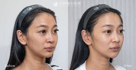  淨妍醫美案例分享_神力拉提_中臉