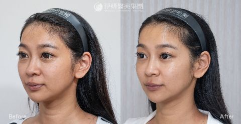  淨妍醫美案例分享_神力拉提_中臉