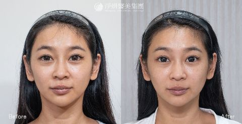 淨妍醫美案例分享_神力拉提_中臉