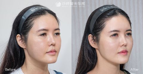 淨妍醫美案例分享_神力拉提_中臉